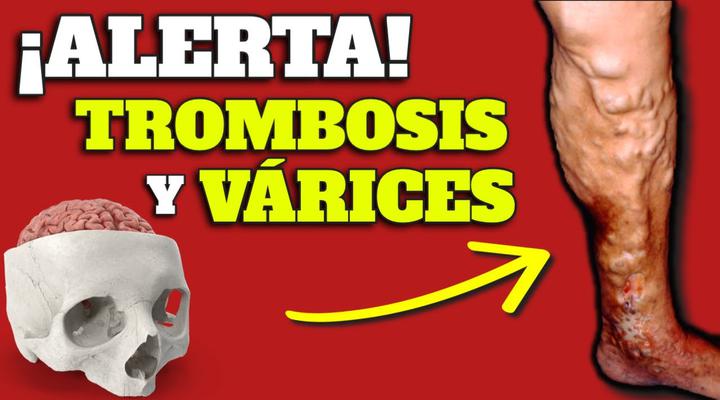 ¿Sabías que las várices te pueden causar trombosis?